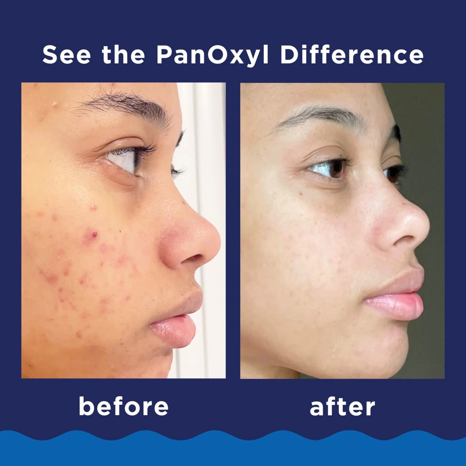 PanOxyl 10% Benzoyl Peroxide Acne Foaming Wash, Clear Acne, 5.5 Oz - Image 5